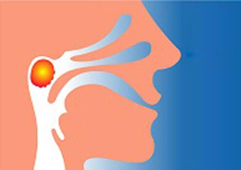 Adenoidectomy recovery
