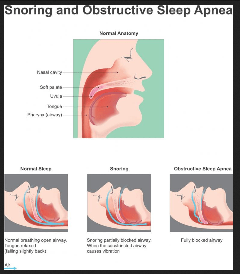 airway