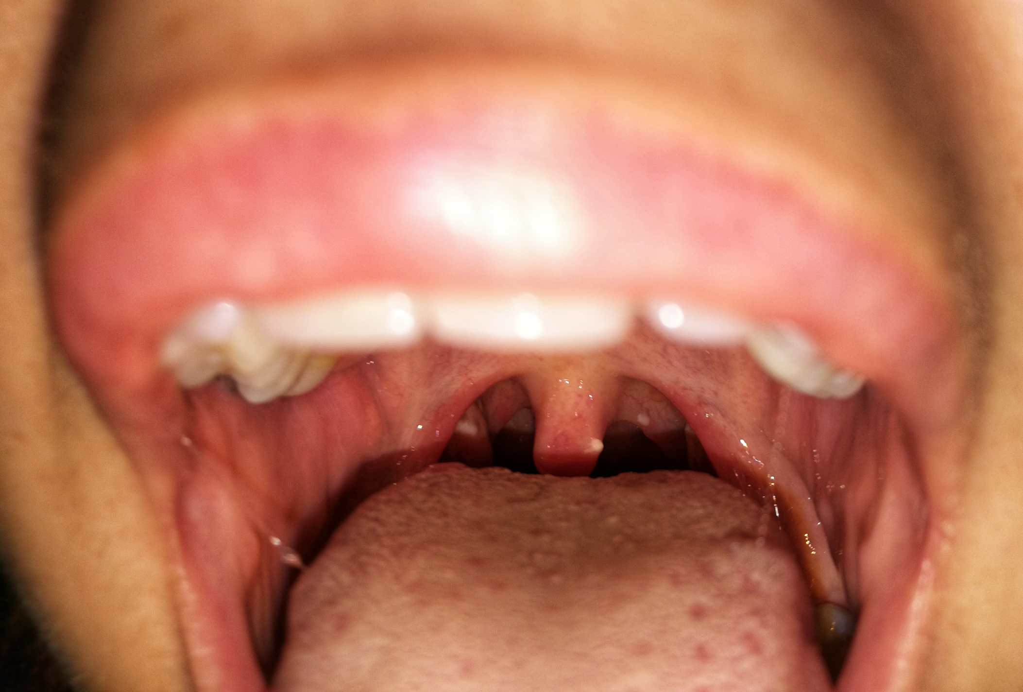 plaques with pus on tonsils gland in both sides